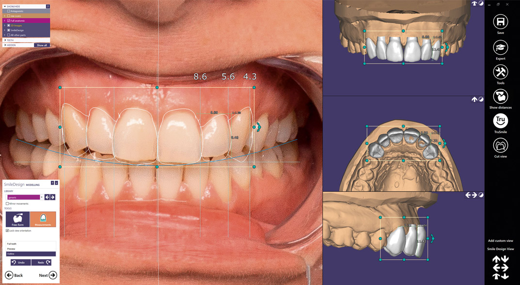 Impronta dentale digitale