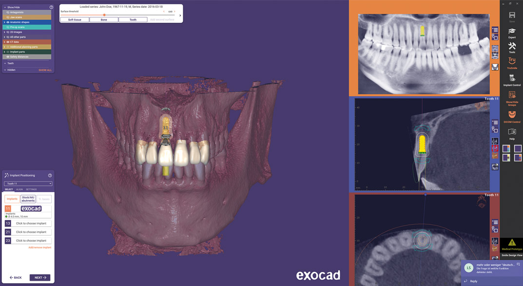 Impronta dentale digitale