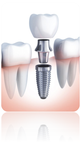 Impronta dentale digitale